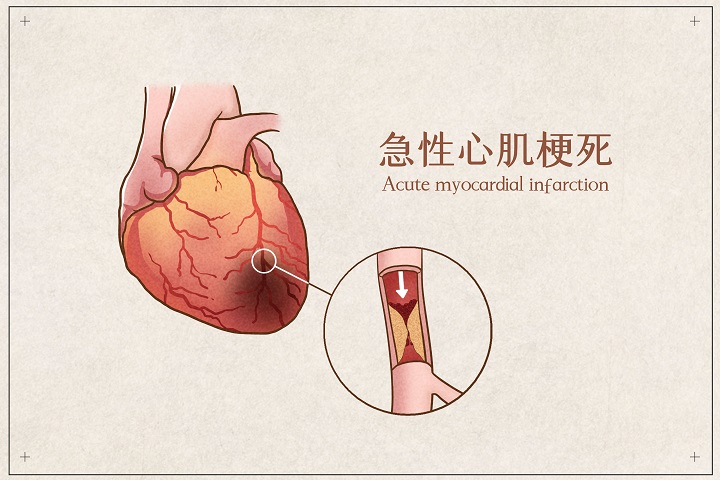 401789173急性心肌梗.jpg